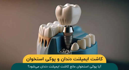 ایمپلنت-دندان-پوکی-استخوان